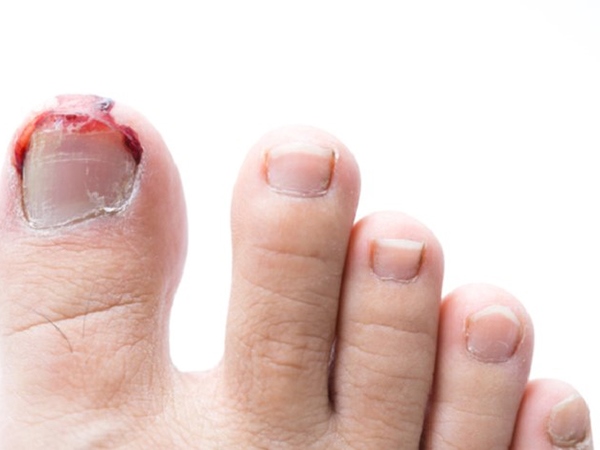 Ngủ mơ thấy móng chân có ý nghĩa gì tốt hay xấu?